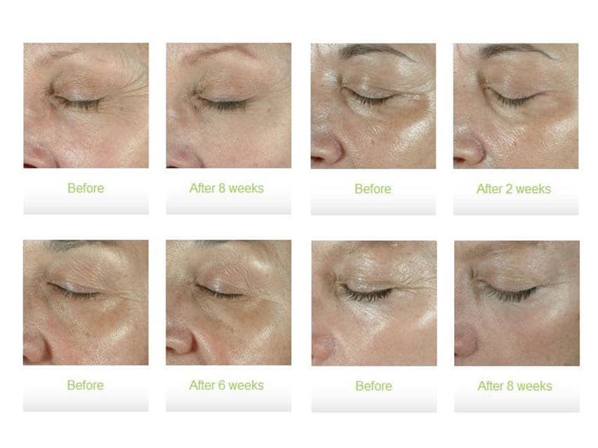 Obagi ELASTIderm Eye Cream before and after photos. Shop LovelySkin for Obagi eye treatments and top-rated skincare.