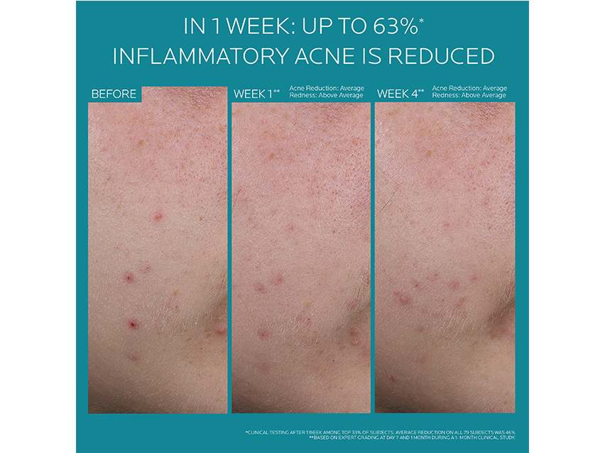La Roche-Posay Effaclar BPO + M Multi-Target Acne Treatment