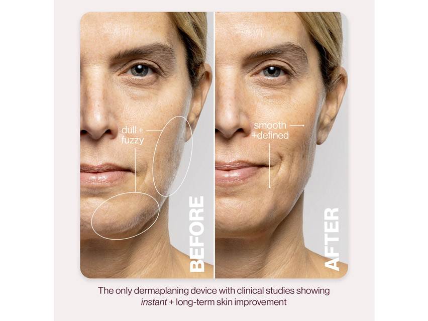 DERMAFLASH LUXE+ Anti-Aging, Exfoliation + Peach Fuzz Removal Set
