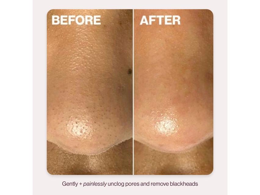 DERMAFLASH DERMAPORE+ Ultrasonic Pore Extractor &amp; Skincare Infuser
