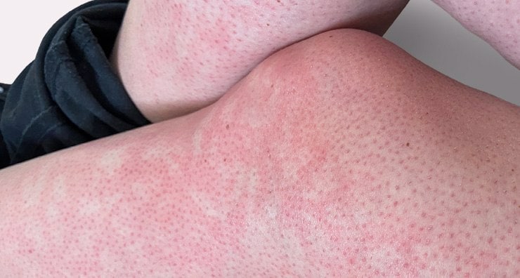 Laptop rash and erythema ab igne: What you need to know