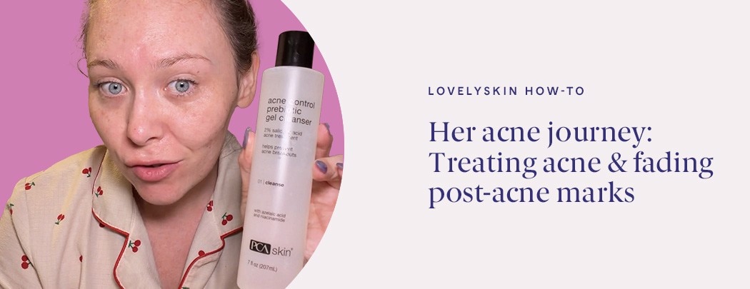 A girl with fair skin and blue eyes holds a bottle of PCA SKIN Acne Control Prebiotic Gel Cleanser.