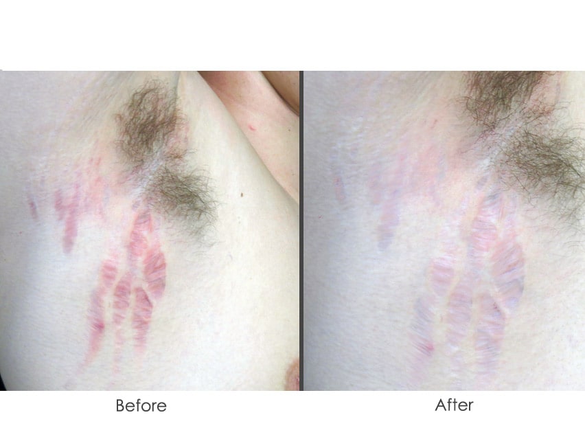 Biodermis Dermasof Skin Repair Serum for Stretch Marks
