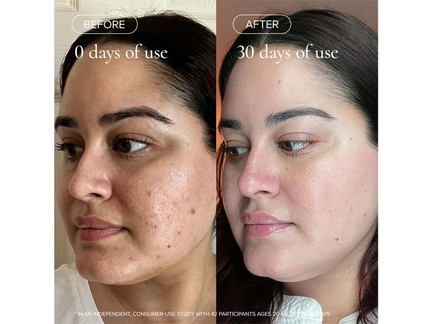 MARA Clear Skin Mineral Milk Acne Treatment