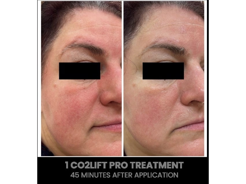 CO2LIFT Pro Carboxy Gel Treatment