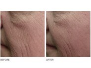 dr dennis gross drx spectralite faceware pro