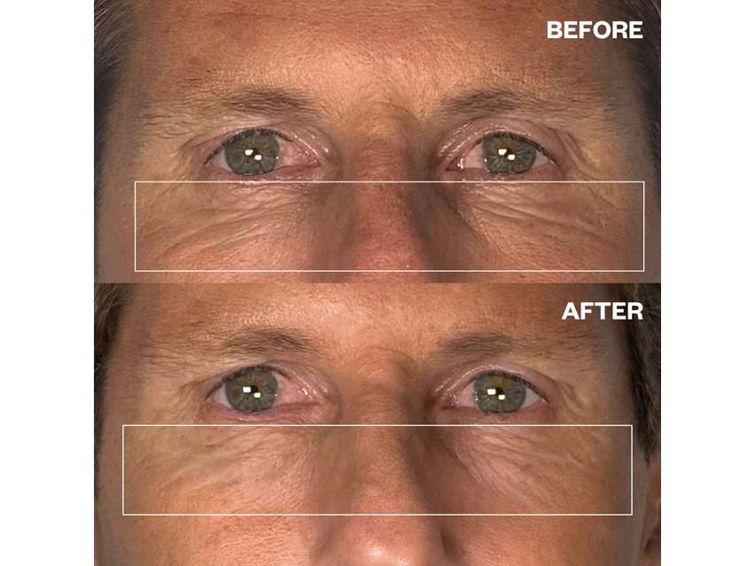 Wrinkles Schminkles Men's Pro Eye Wrinkle Patches