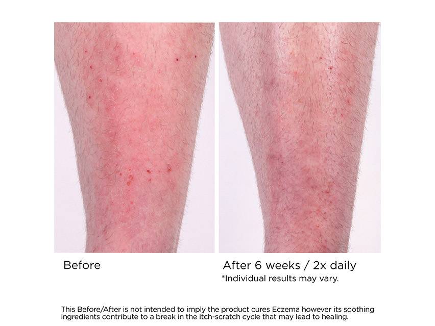 NassifMD&#174; Eczema Soothing Skin Cream