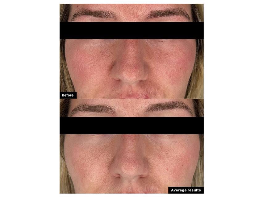 SkinCeuticals Clear Daily Soothing UV Defense Sunscreen: Before and after
