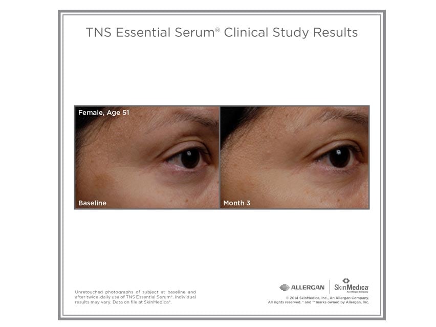 SkinMedica TNS Essential Serum before and after photos. Shop LovelySkin for SkinMedica anti-aging serum products.