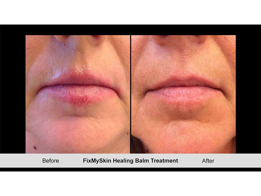FixMySkin 1% Hydrocortisone Healing Lip Balm – Vanilla &amp; Unflavored - Pack of 6